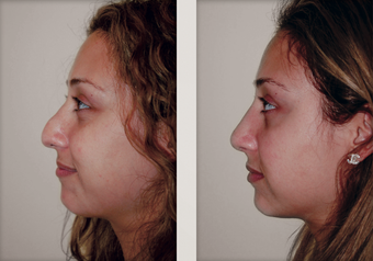 Rhinoplasty before 501144