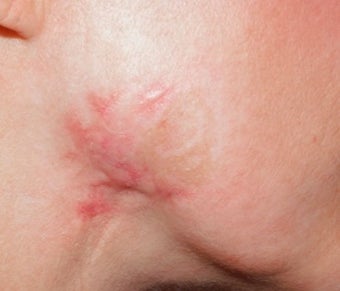 Vbeam for scar on jawline after 374542