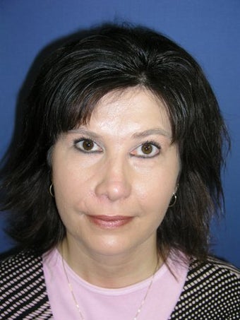 Facial Scar Improvement after 598645