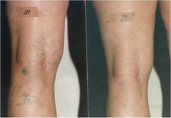 Vein Removal with Sclerotherapy before 600385