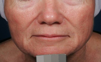 Fillers - Sculptra after 136191