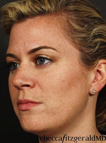 Sculptra / IPL after 318457
