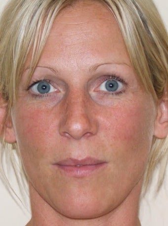 Sculptra after 346261