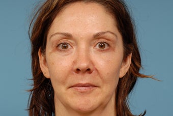 Sculptra after 374334