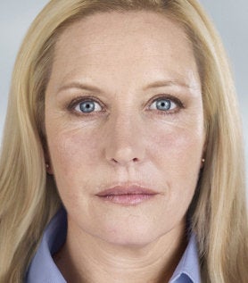 Sculptra after 391584