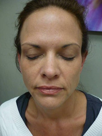 Sculptra after 600387