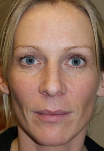Sculptra before 346261