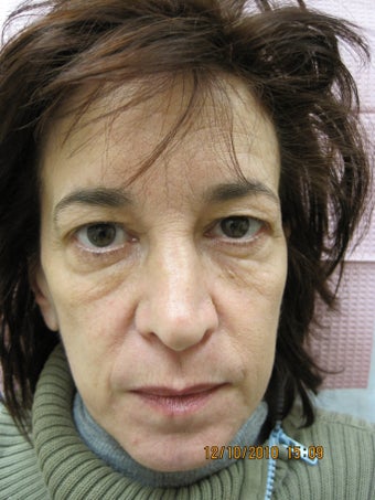 Sculptra before 363497