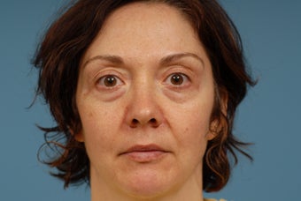 Sculptra before 374334