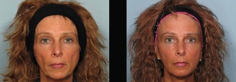 Sculptra before 460617