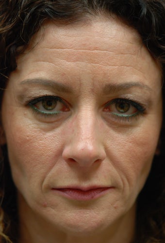 Sculptra Aesthetic before 581294