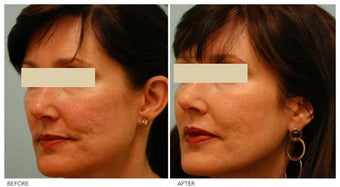 Acne Scarring Correction after 136802