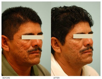 Acne Scarring Correction before 136800