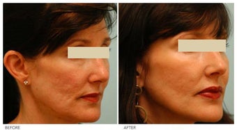 Acne Scarring Correction before 136802
