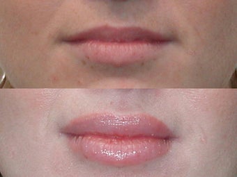 Lip Augmention with Silicone before 137744