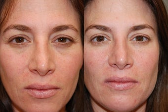 Non-Surgical Facial Rejuvenation with Silikon-1000 and Botox before 146221