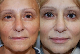 Non-Surgical Facial Rejuvenation and Lip Augmentation with Silikon-1000