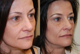 Non-Surgical Facial rejuvenation with Silikon-1000 and Botox. before 500582