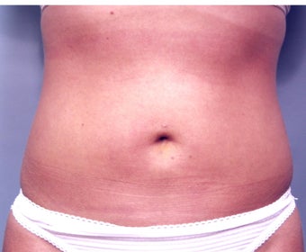 Slim Lipo after 137505