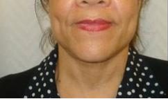Laser Liposuction after 221271