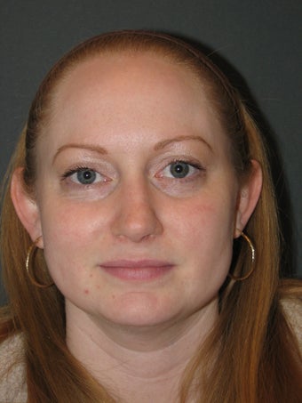 Smartlipo of the Neck and Jowls after 316496