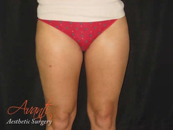 Smart Lipo - Outer Thighs after 379515