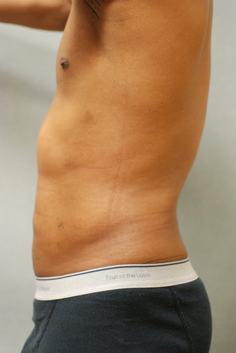 SmartLipo™ Restoration of a Male's Abs after 450440