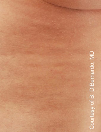Smart Lipo after 606714