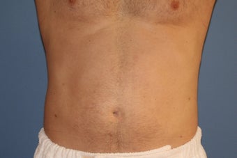Smartlipo after 91253