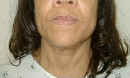 Laser Liposuction before 221271