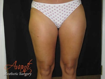 Smart Lipo - Outer Thighs before 379515