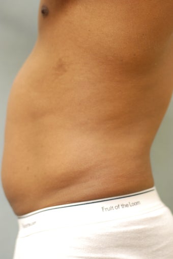 SmartLipo™ Restoration of a Male's Abs before 450440