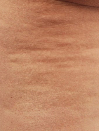 Smart Lipo before 606714