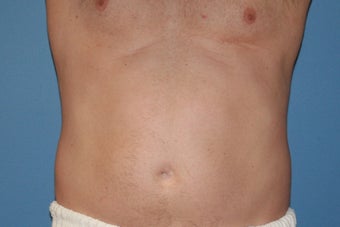 Smartlipo before 91253
