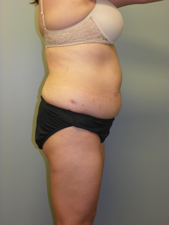 SMARTLIPO MPX before 235097