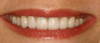 Veneers after 343105