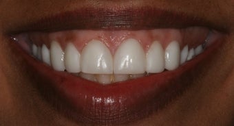 Veneers, gumlift before 358197