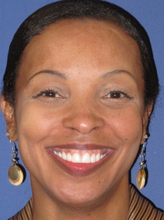 Veneers, gumlift 358197