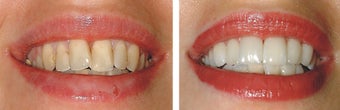 Smile makeover before 607190