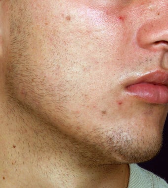 Acne Laser Treatment