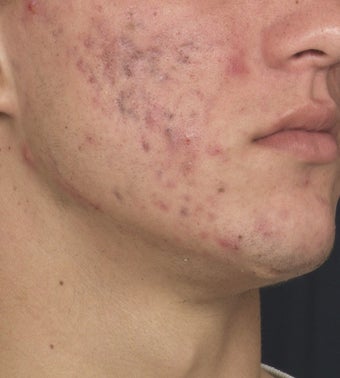 Acne Laser Treatment