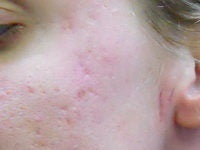 Acne/Acne Scars Treatment with Smoothbeam before 272005