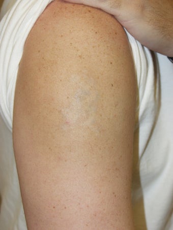 Laser Tattoo Removal photo from Louis M. DeJoseph, MD, Atlanta Facial ...