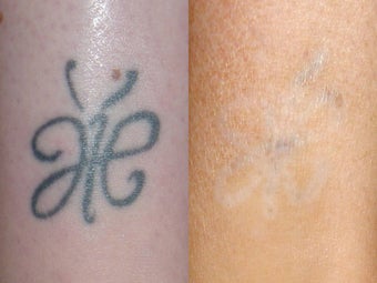 Laser Tattoo Removal before 96290