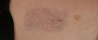 QSR Ruby Laser Tattoo Removal after 329677