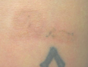 Laser tattoo removal after 374516