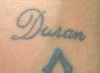 Laser tattoo removal before 374516