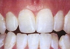 Teeth Whitening (Microabrasion)