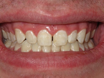 ICON- White Spot Treatment after 300596