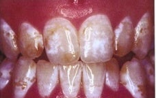 Teeth Whitening (Microabrasion)